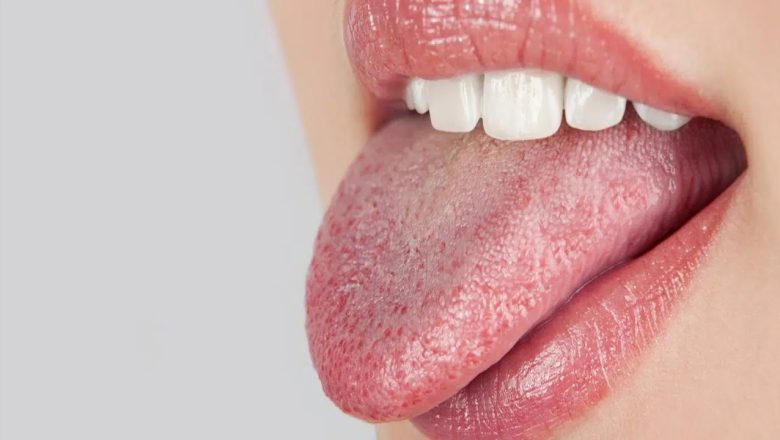 Details and Advice on Dry Mouth